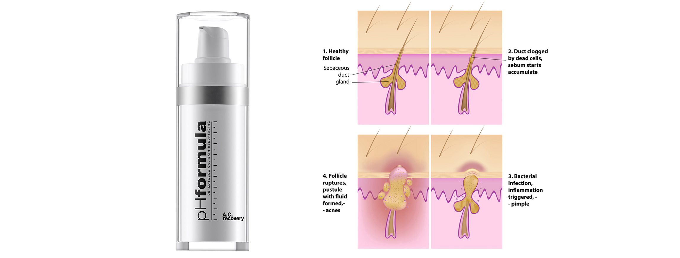 pHformula’s innovative products for treating acne